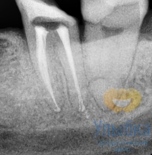 Лечение каналов зубов под микроскопом после лечения