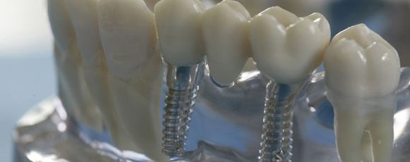 Имплантация зубов, хирургия